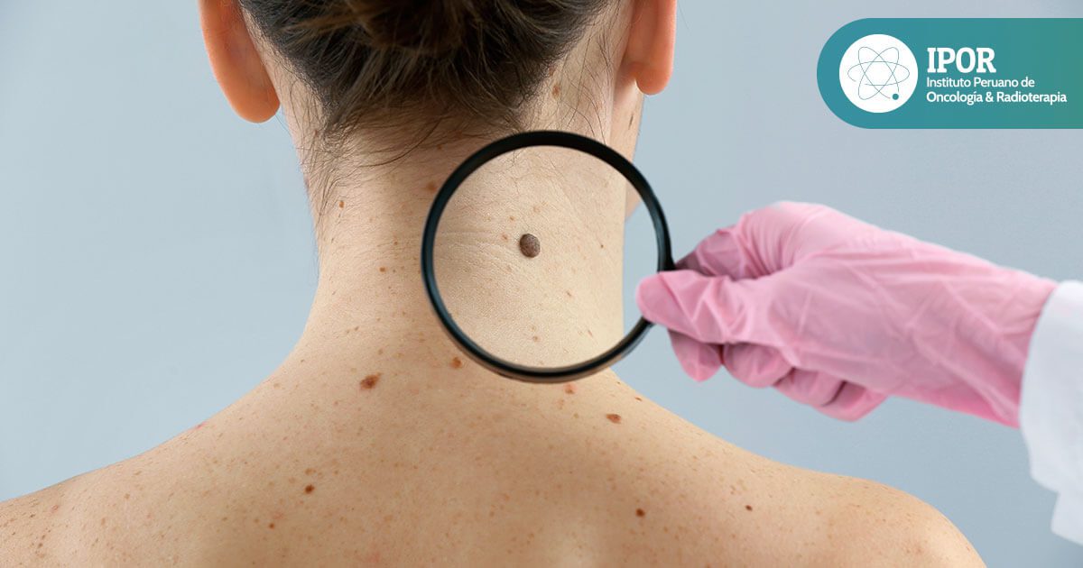 destacada-como-prevenir-el-cancer-de-piel-en-invierno