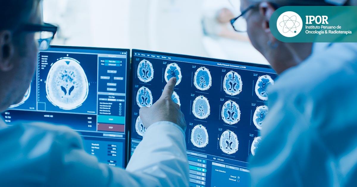 destacada-cuales-son-las-causas-y-factores-del-cancer-cerebral